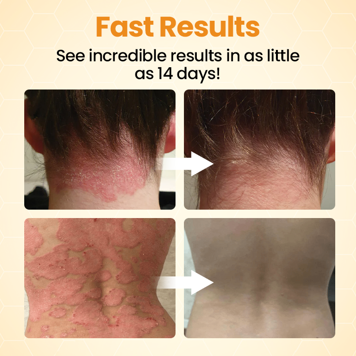 ATTDX® BeeSooth Psoriasis Skin Care Cream