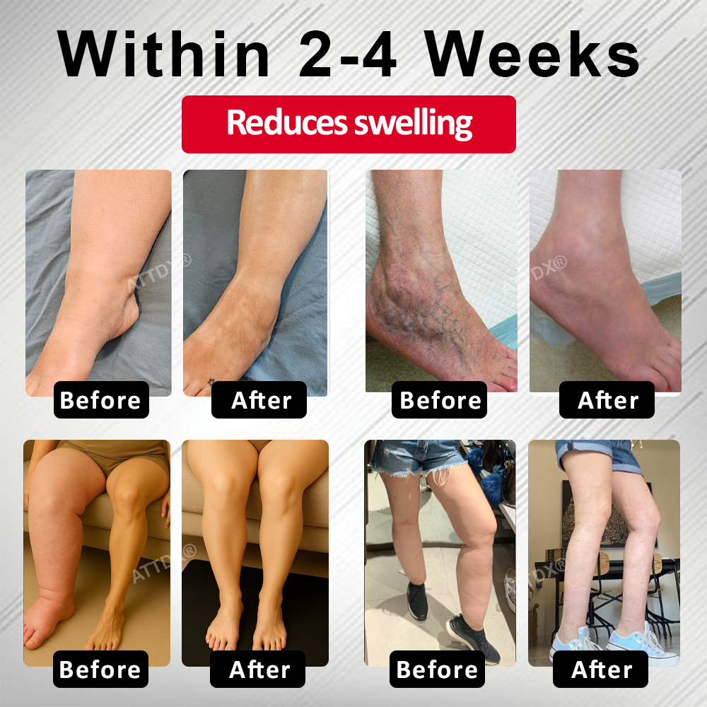 ATTDX® Advanced CVI Edema Therapy Cream