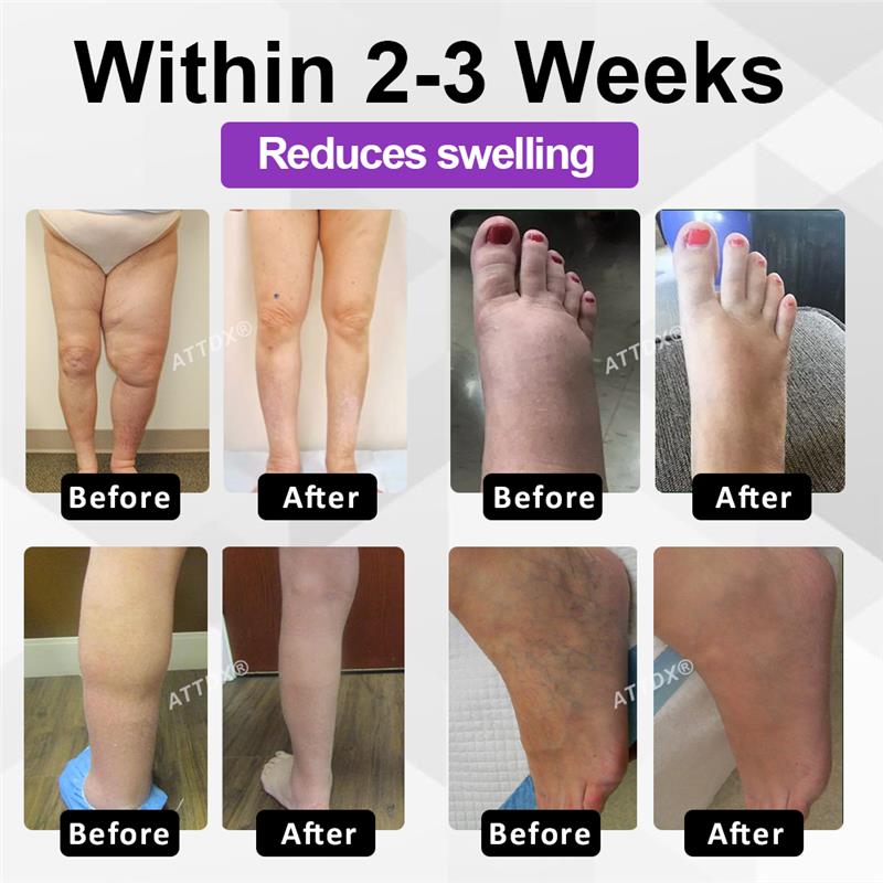 ATTDX® Bilberry EaseFluid Edema Gel