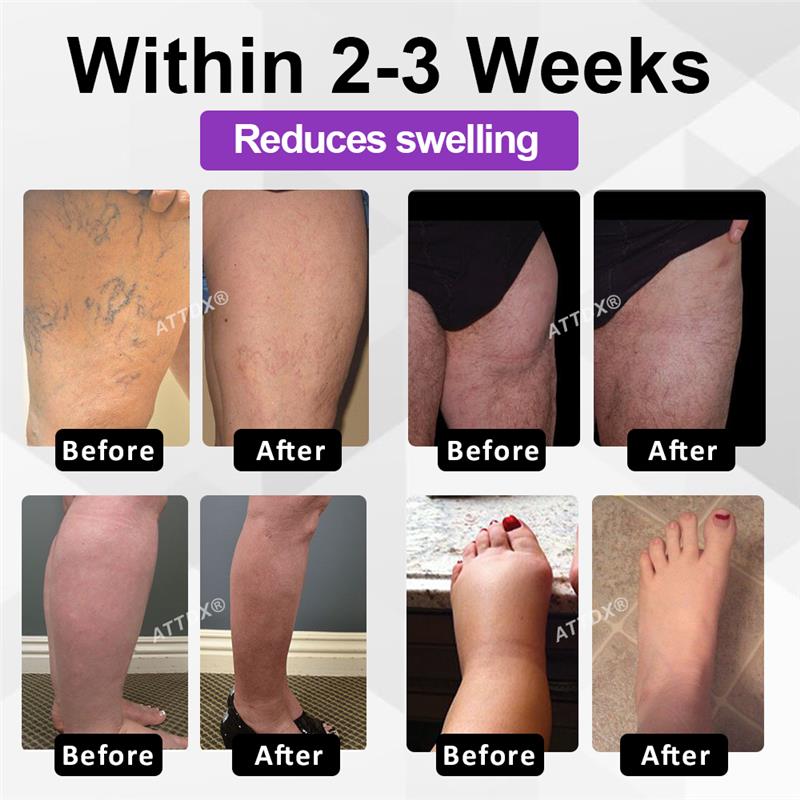 ATTDX® Bilberry EaseFluid Edema Gel
