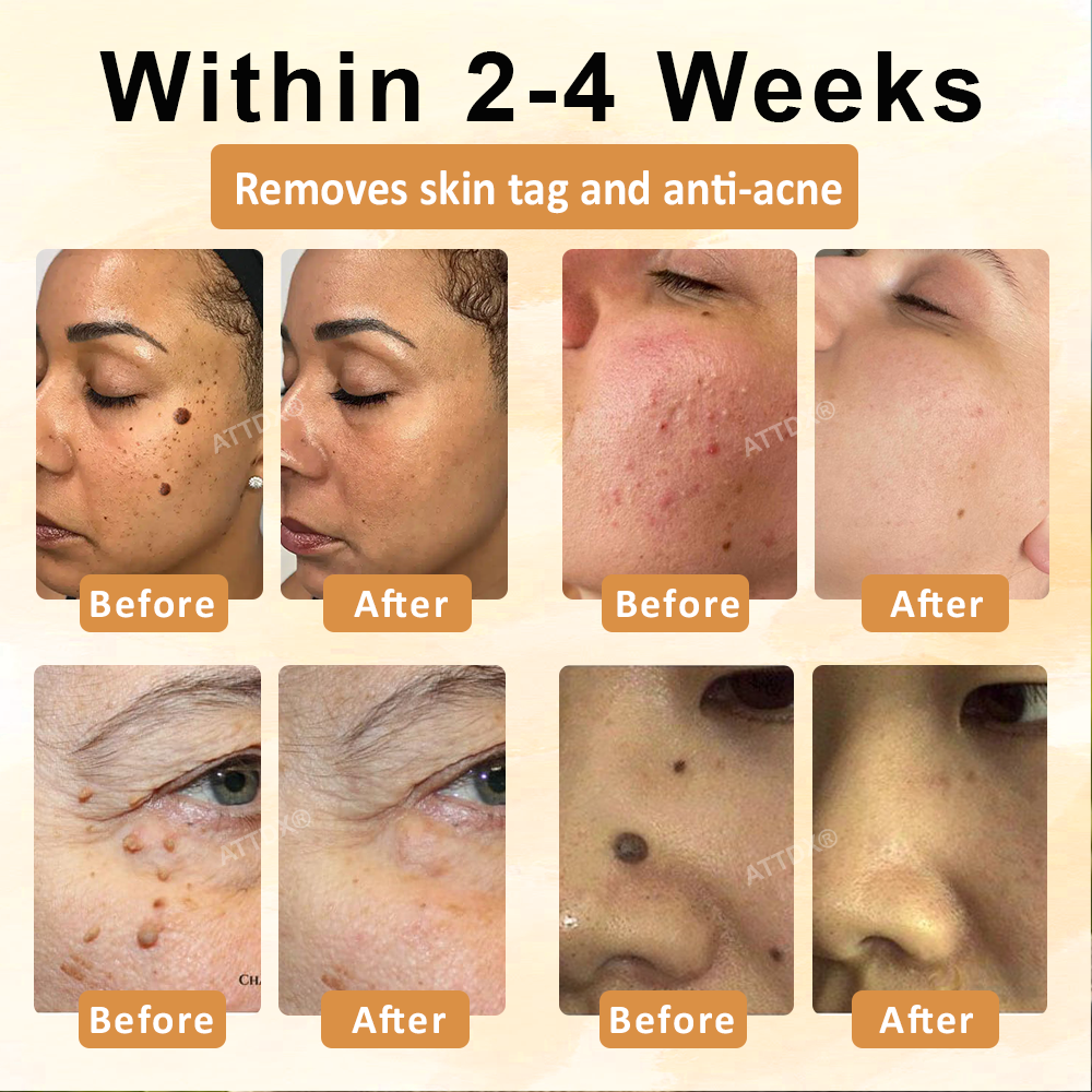 ATTDX® CastorBee Tag & Spots Peel-Off Mask