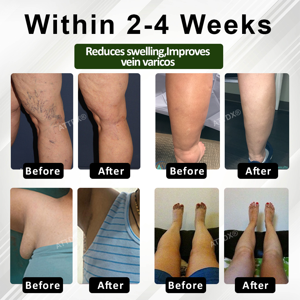 ATTDX® PuffEase Edema Therapy Massage Cream
