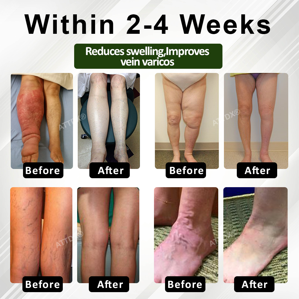 ATTDX® PuffEase Edema Therapy Massage Cream