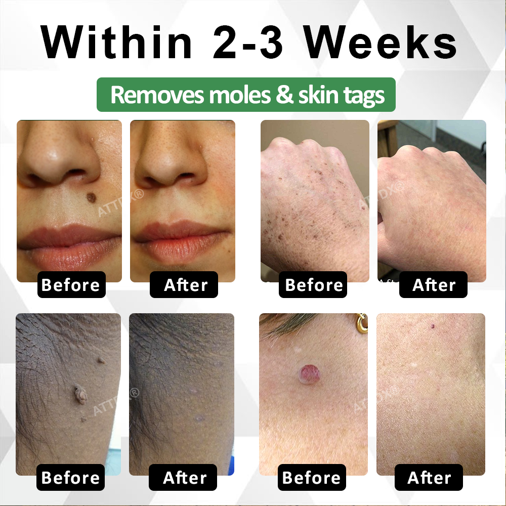 ATTDX® Herdle Shot Spot & Mole Correct Serum