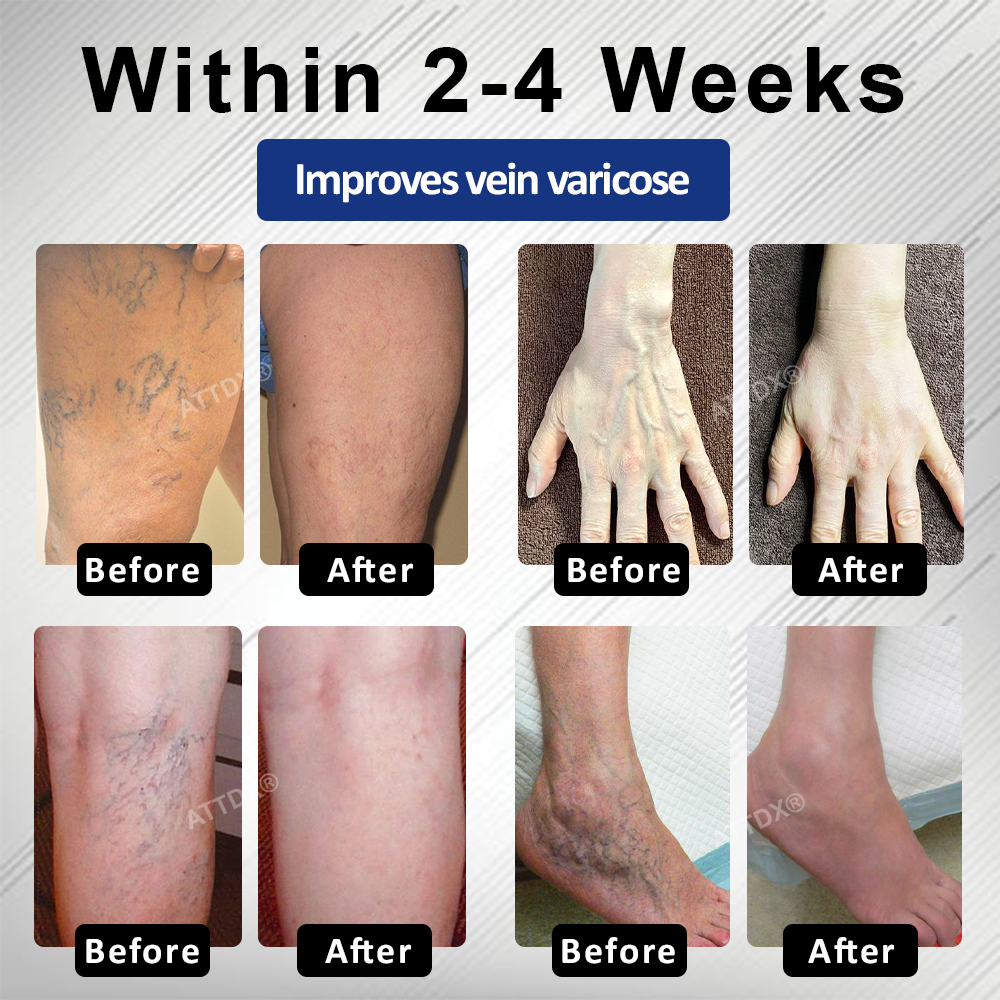 ATTDX® MagniLift VeinErase Spray