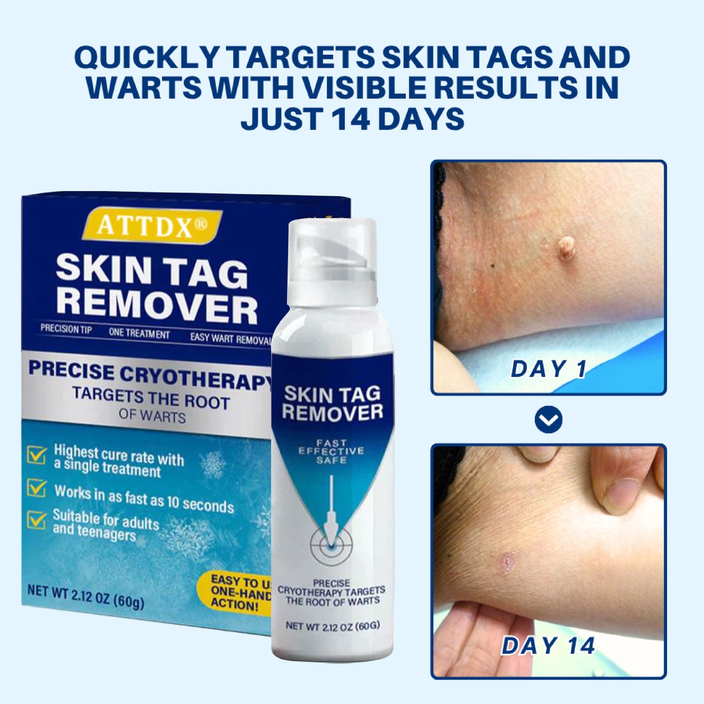 ATTDX® TagRecede Cryo Treatment Spray