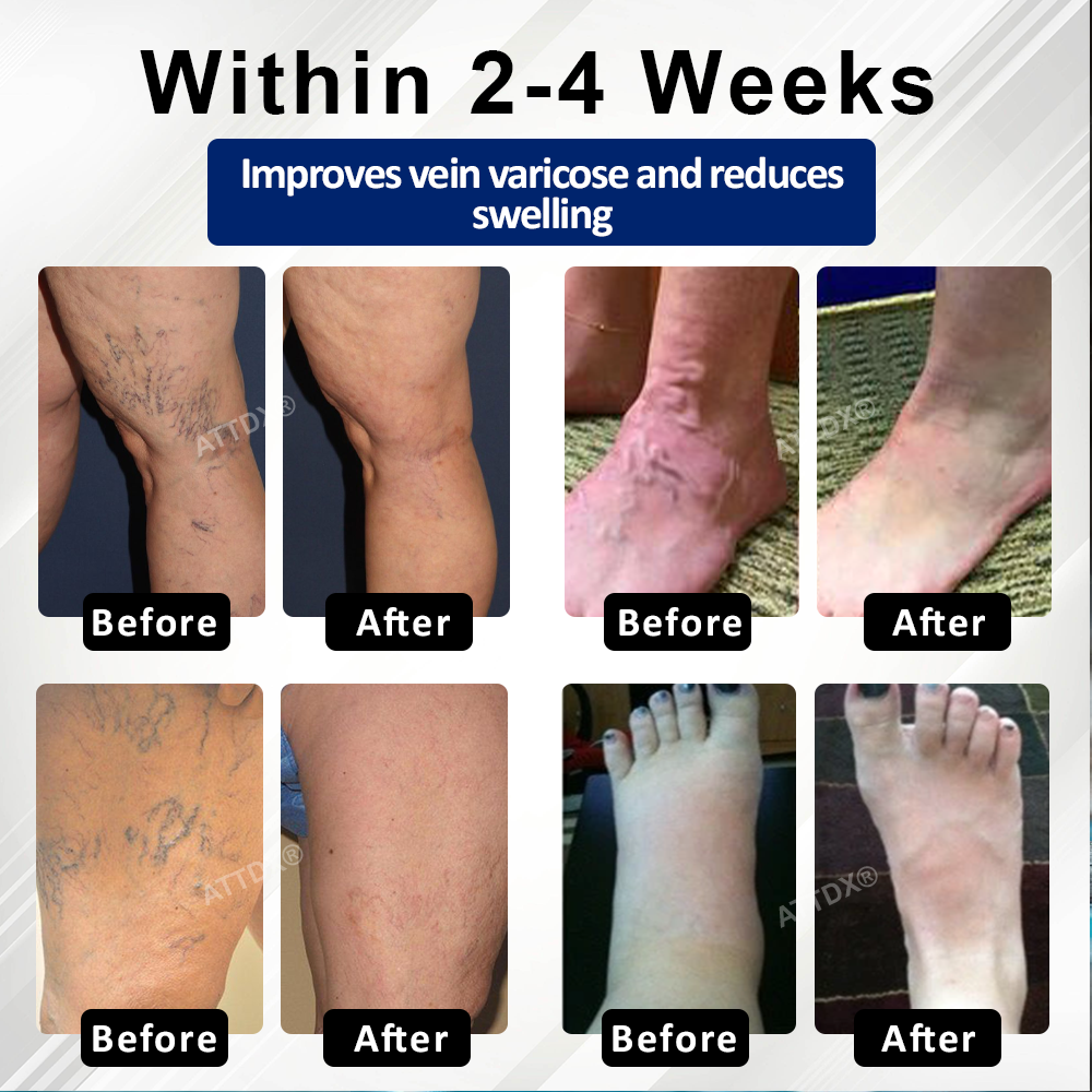 ATTDX® VeinFocus Microneedle Leg Patch