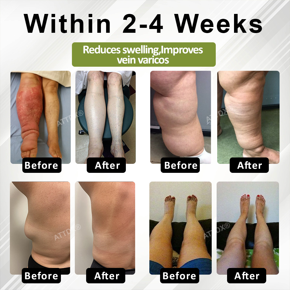 ATTDX® VeinoRoll Therapy Edema Comfort Cream
