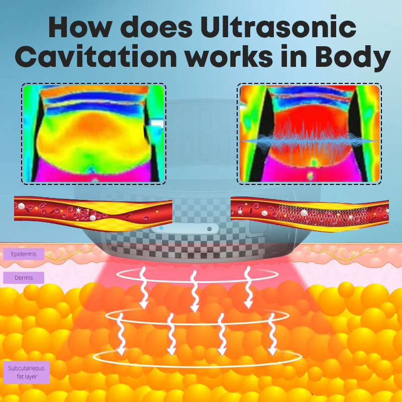 LipidMelt Ultrasonic DetoxBracelets