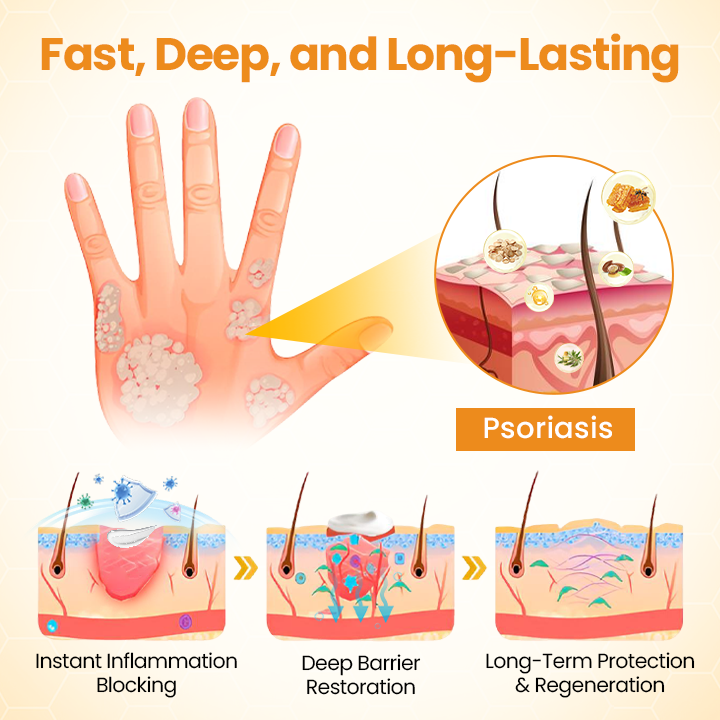 ATTDX® BeeSooth Psoriasis Skin Care Cream
