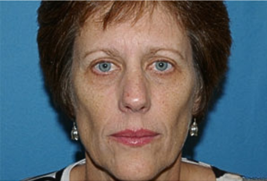 ATTDX® PDRN-NAD+ Cica Reedle Shot Serum 29 ATTDX® PDRN-NAD+ Cica Reedle Shot Serum