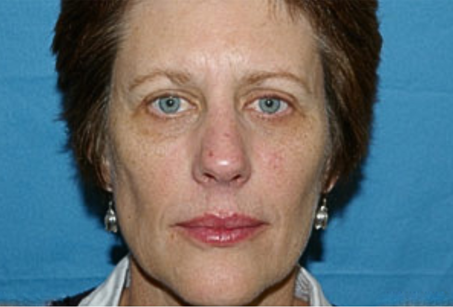 ATTDX® PDRN-NAD+ Cica Reedle Shot Serum 30 ATTDX® PDRN-NAD+ Cica Reedle Shot Serum