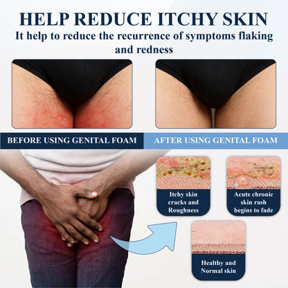 ATTDX® Advanced HPV & Rash Relief Genital Foam