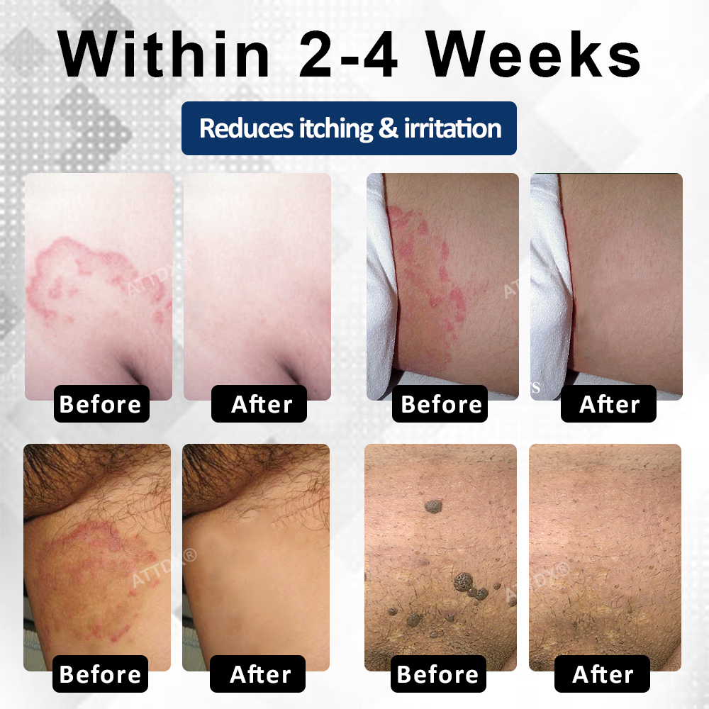 ATTDX® Advanced HPV & Rash Relief Genital Foam