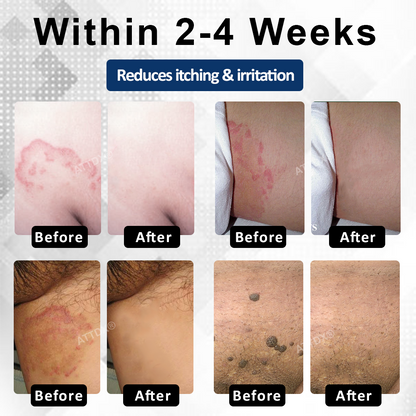 ATTDX® Advanced HPV & Rash Relief Genital Foam