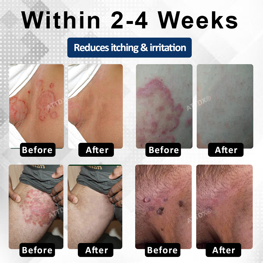 ATTDX® Advanced HPV & Rash Relief Genital Foam