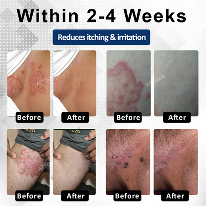 ATTDX® Advanced HPV & Rash Relief Genital Foam