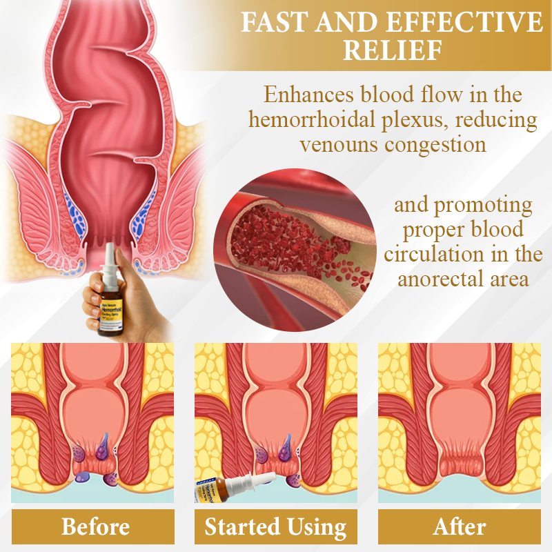 ATTDX® Apis Venom Hemorrhoid Cooling Spray 23 ATTDX® Apis Venom Hemorrhoid Cooling Spray