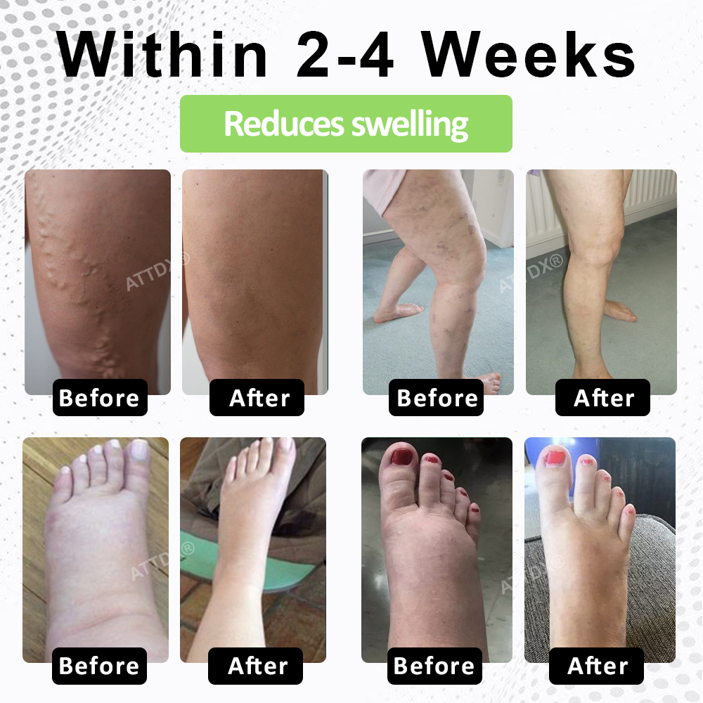 ATTDX® CircuPro Edema & Lymphatic Support Inhaler