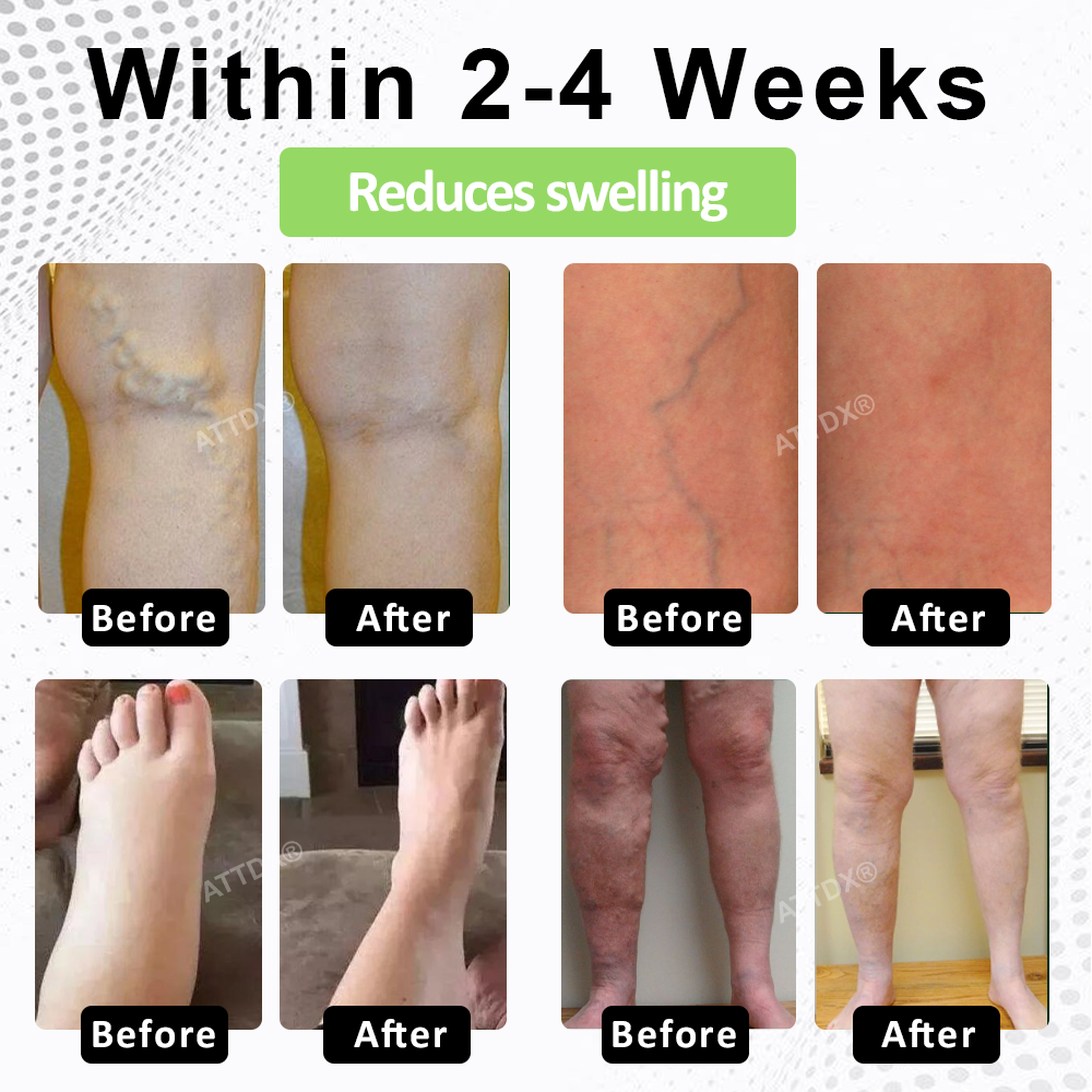 ATTDX® CircuPro Edema & Lymphatic Support Inhaler