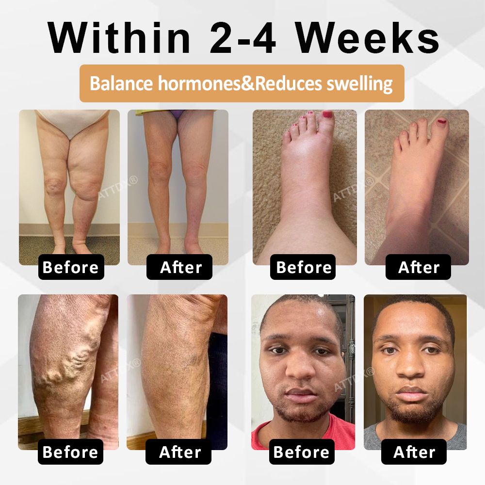 ATTDX® CortiEase Hormonal Swelling Balance Cream