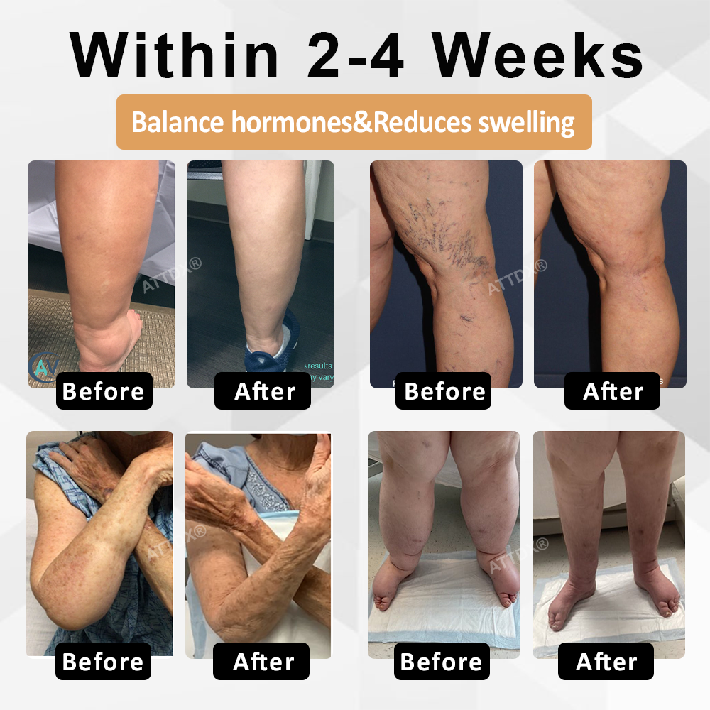 ATTDX® CortiEase Hormonal Swelling Balance Cream