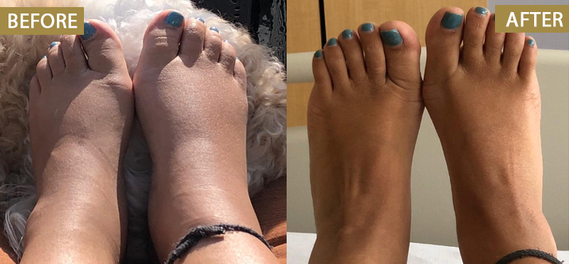 ATTDX® Bromelain Edema & Vein Care Cream 31 ATTDX® Bromelain Edema & Vein Care Cream