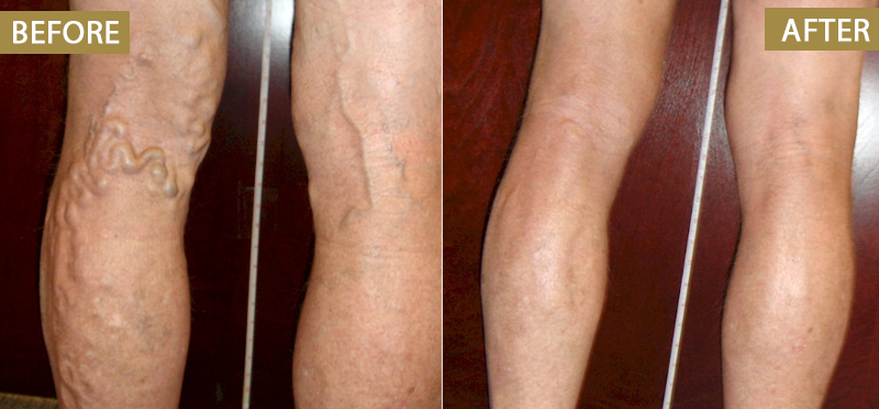 ATTDX® Bromelain Edema & Vein Care Cream 32 ATTDX® Bromelain Edema & Vein Care Cream