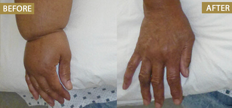 ATTDX® Bromelain Edema & Vein Care Cream 33 ATTDX® Bromelain Edema & Vein Care Cream