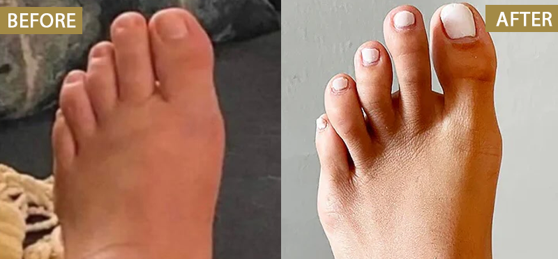 ATTDX® Bromelain Edema & Vein Care Cream 35 ATTDX® Bromelain Edema & Vein Care Cream