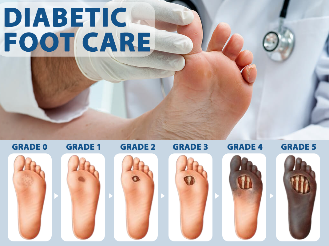 ATTDX® Diabetes Foot Guard Fast Recovery Spray 30 ATTDX® Diabetes Foot Guard Fast Recovery Spray