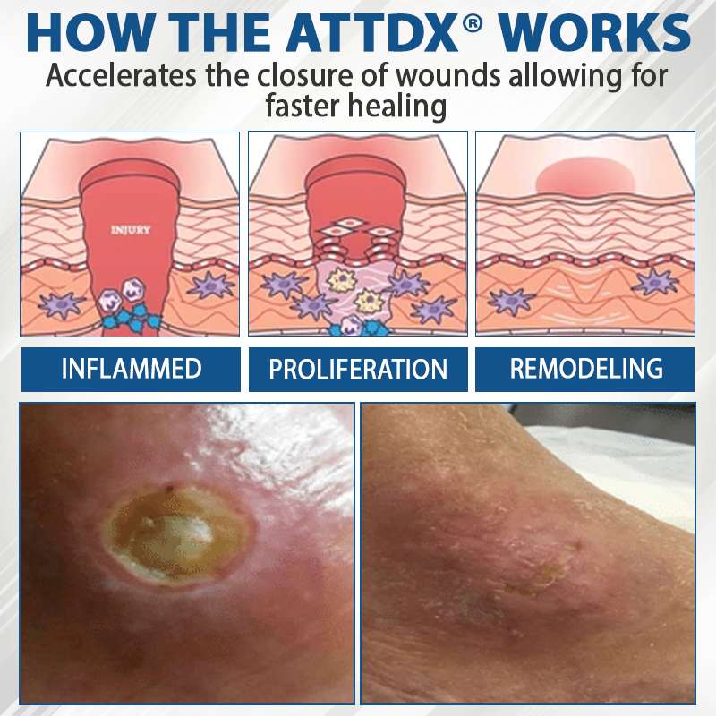 ATTDX® Diabetes Foot Guard Fast Recovery Spray 35 ATTDX® Diabetes Foot Guard Fast Recovery Spray