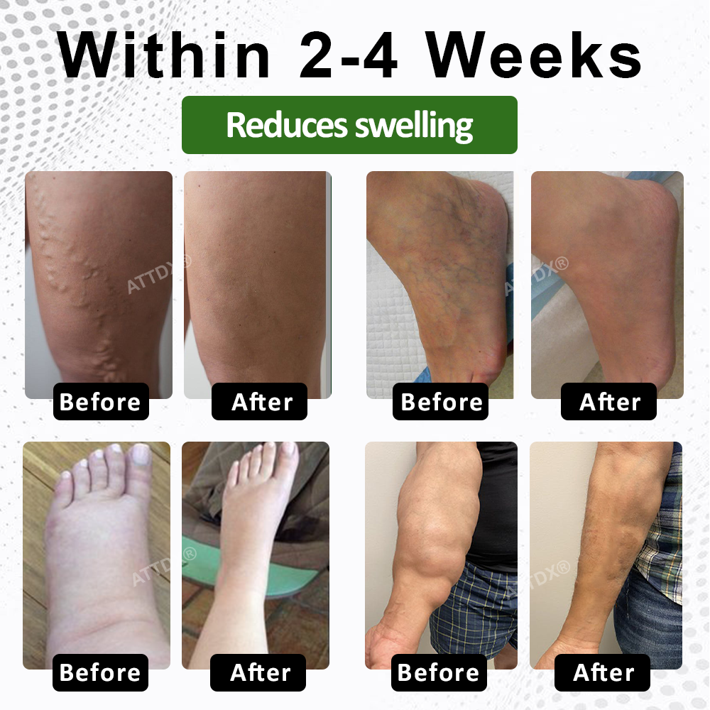 ATTDX® FluidiQ Edema Support Spray