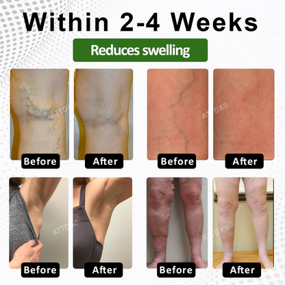 ATTDX® FluidiQ Edema Support Spray