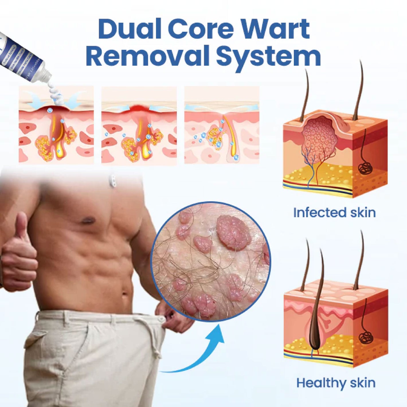 ATTDX® GentX WartRelief Cream image ATTDX® GentX WartRelief Cream