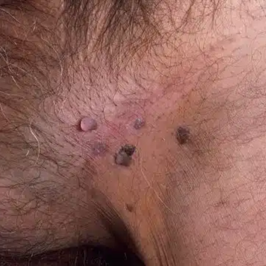 ATTDX® GentX WartRelief Cream image ATTDX® GentX WartRelief Cream