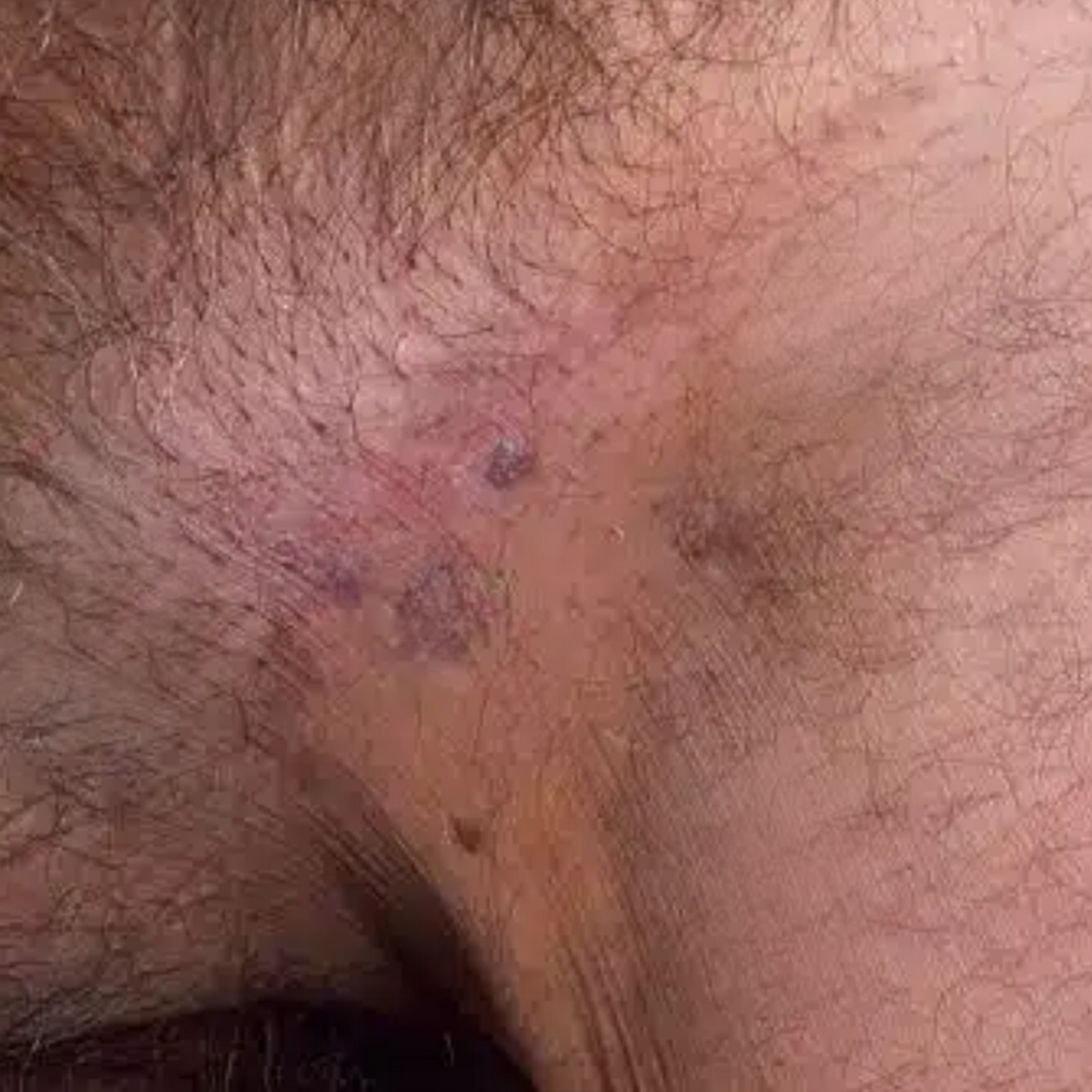 ATTDX® GentX WartRelief Cream image ATTDX® GentX WartRelief Cream