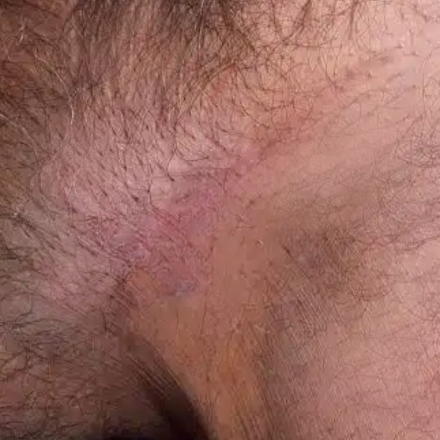 ATTDX® GentX WartRelief Cream image ATTDX® GentX WartRelief Cream