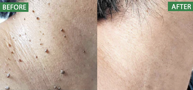 ATTDX® Herdle Shot Spot & Mole Correct Serum 27 ATTDX® Herdle Shot Spot & Mole Correct Serum