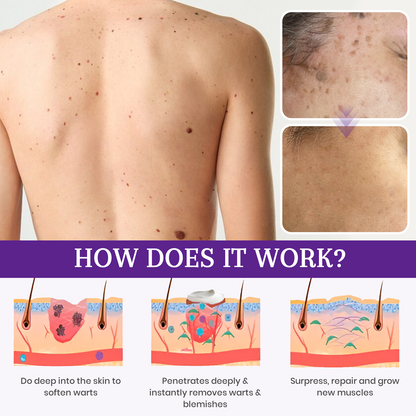 ATTDX® Instant Mole & Spot NatureStore Cream