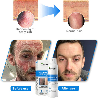 ATTDX® Magnesium Herbal Soothing Spray 👨‍⚕️ MHRA Approved