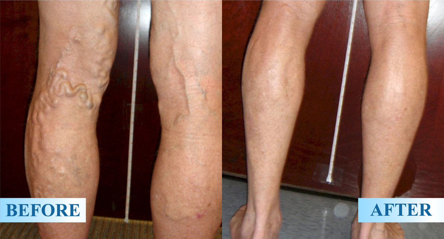 ATTDX® MagniLift VeinErase Spray 27 ATTDX® MagniLift VeinErase Spray