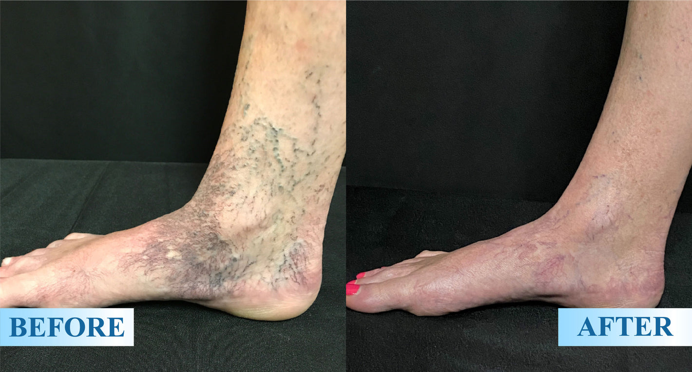 ATTDX® MagniLift VeinErase Spray 28 ATTDX® MagniLift VeinErase Spray