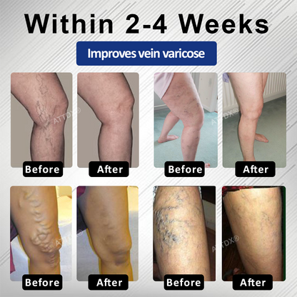 ATTDX® MagniLift VeinErase Spray