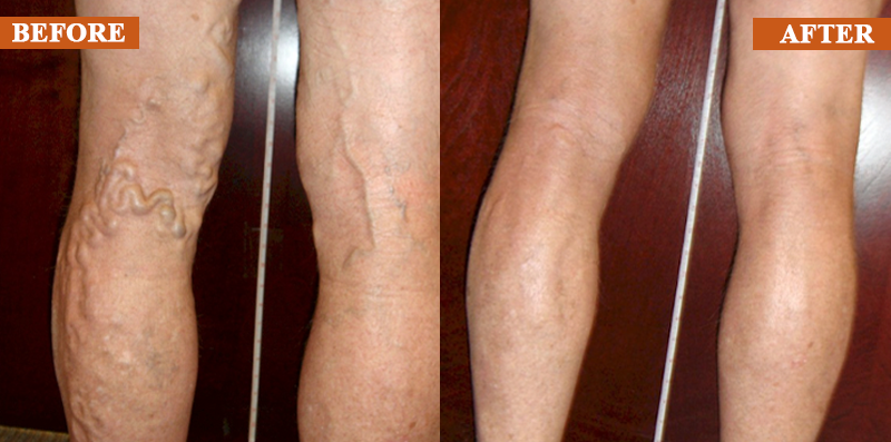 ATTDX® ManukaRelief Edema Therapy Cream 28 ATTDX® ManukaRelief Edema Therapy Cream