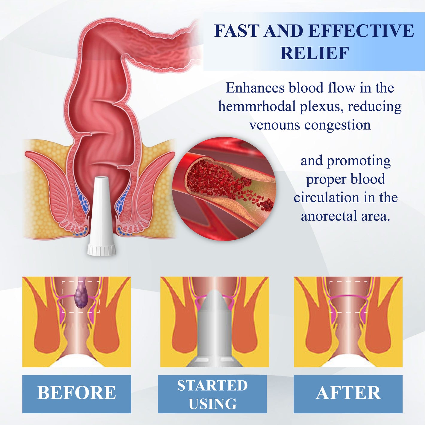 ATTDX® Medical Hemorrhoid Herbal Gel with Applicator 22 ATTDX® Medical Hemorrhoid Herbal Gel with Applicator