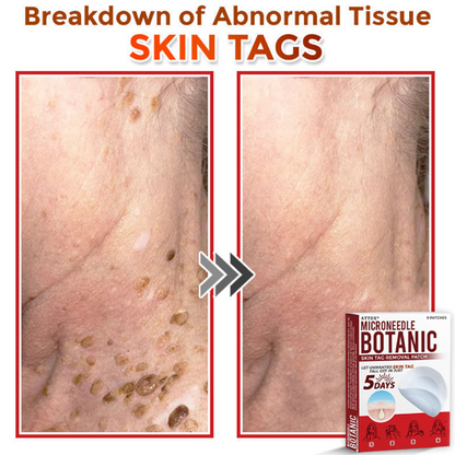 ATTDX® MicroNeedle Botanic Skin Tag Removal Patch