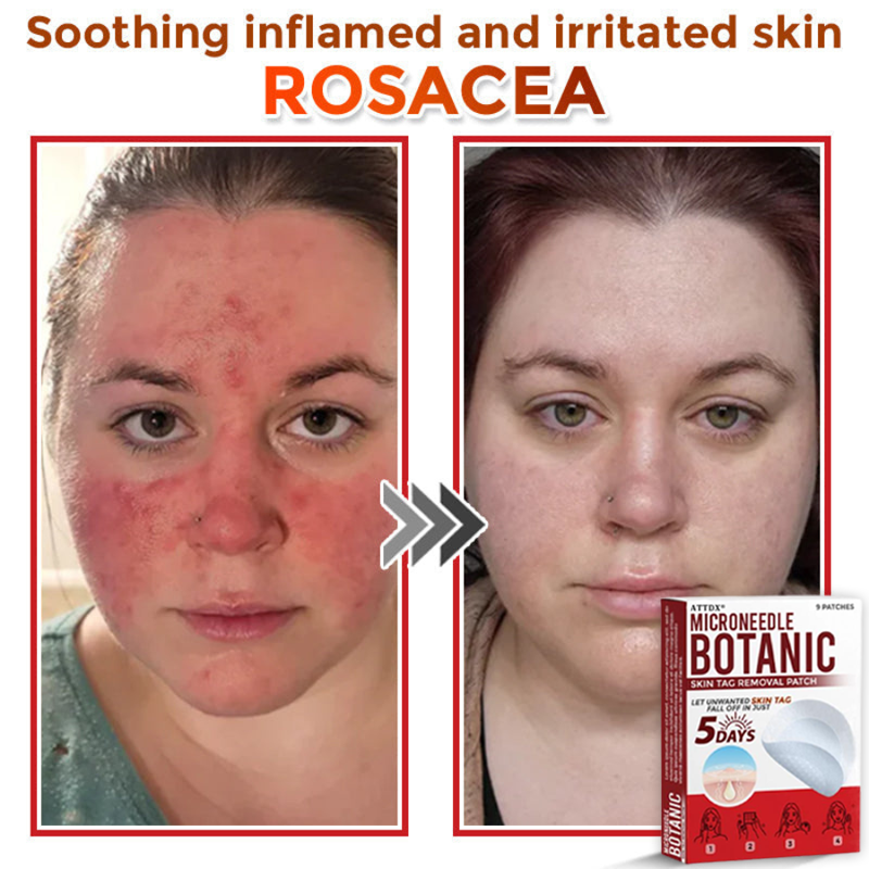 ATTDX® MicroNeedle Botanic Skin Tag Removal Patch
