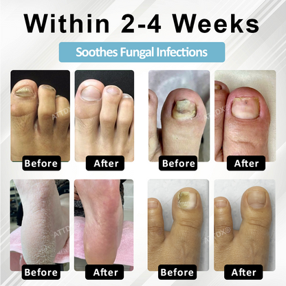 ATTDX® MycoStop Nail Recovery Serum Pen