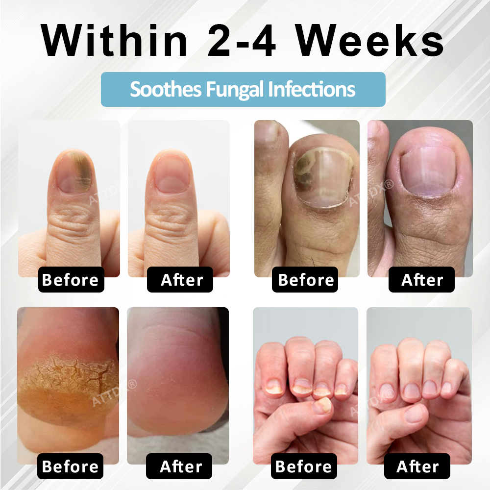 ATTDX® MycoStop Nail Recovery Serum Pen